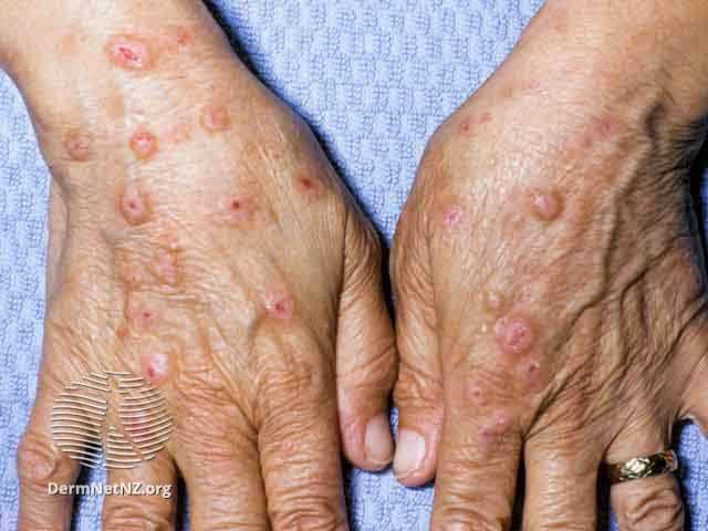 مدیریت پروریگو ندولاریس: نکات و ترفندها