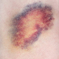 راهنمای مراقبت اولیه کبودی ها: درمان و پیشگیری