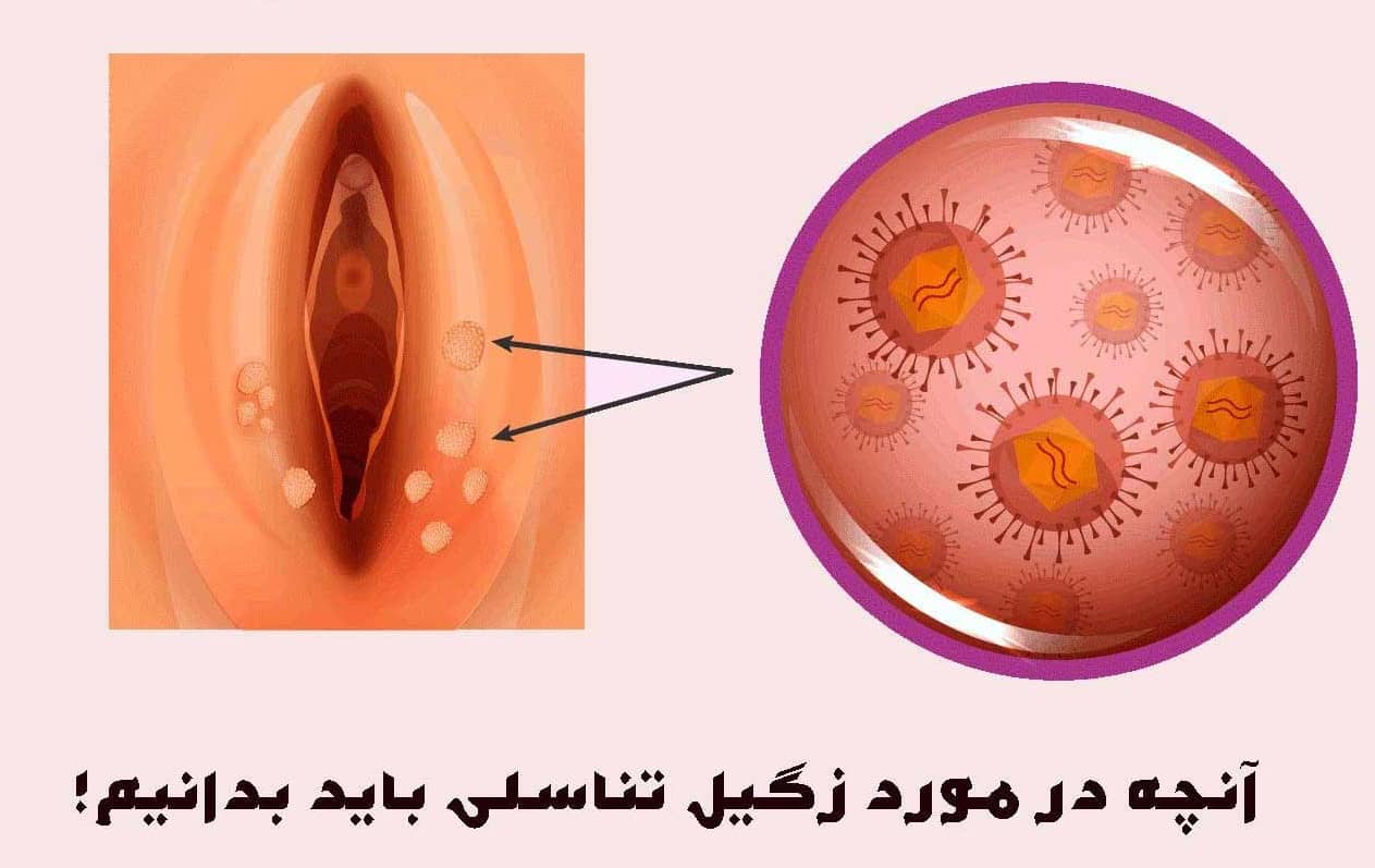 می دانیم که نمی خواهید بپرسید: آیا زگیل تناسلی دارم؟