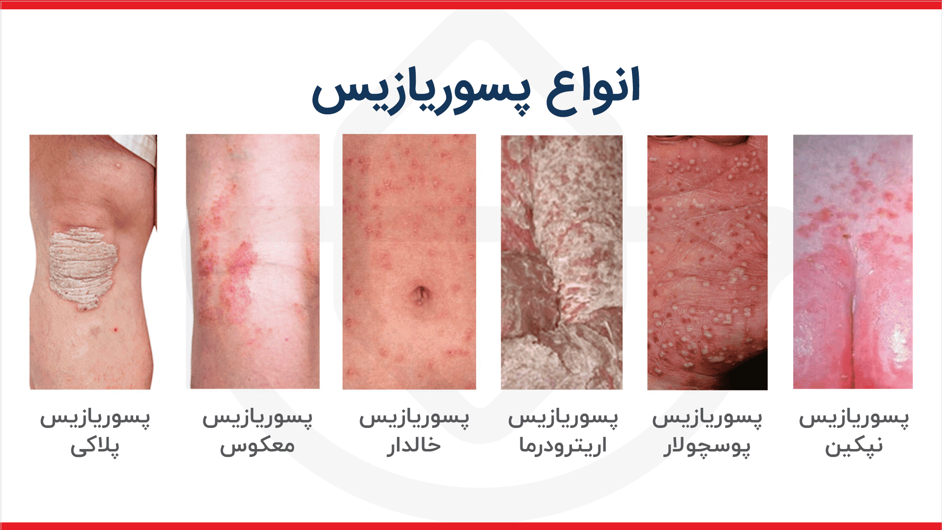 عکس انواع پسوریازیس | آشنایی با انواع مختلف بیماری پوستی پسوریازیس + تصاویر