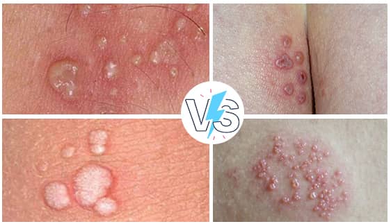 تفاوت بین زگیل تناسلی و تبخال تناسلی چیست؟