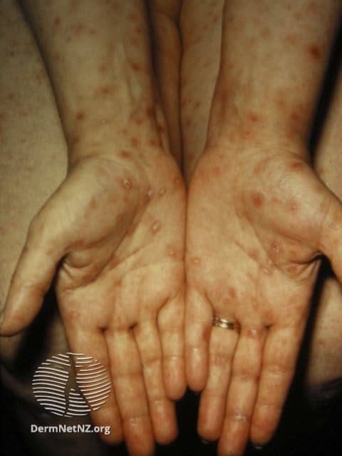 سیفلیس ثانویه