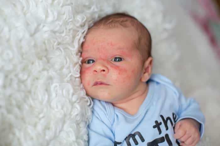 آکنه نوزاد (Baby Acne (Neonatal Acne))