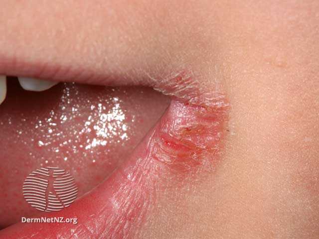 شیلیت زاویه ای