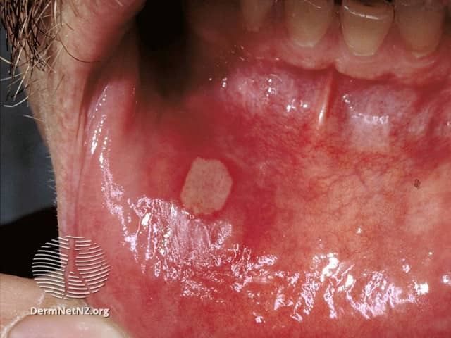 آفت دهان (Canker Sore (Aphthous Ulcer))