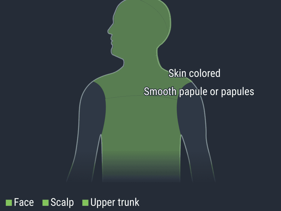 تریچودیسکوما