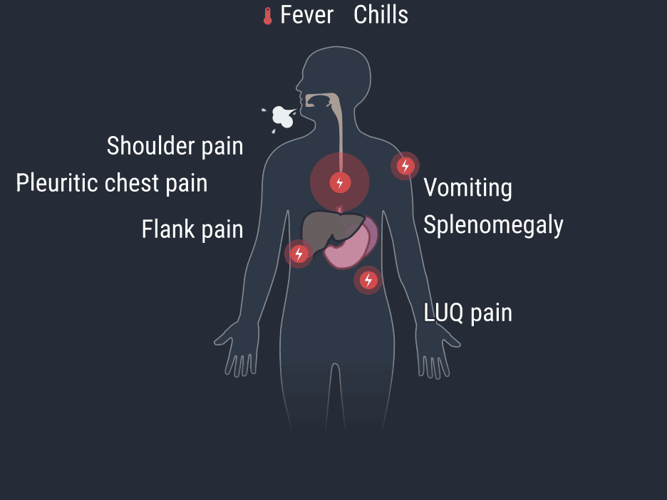انفارکتوس طحال