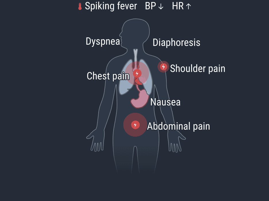آبسه زیر دیافراگم