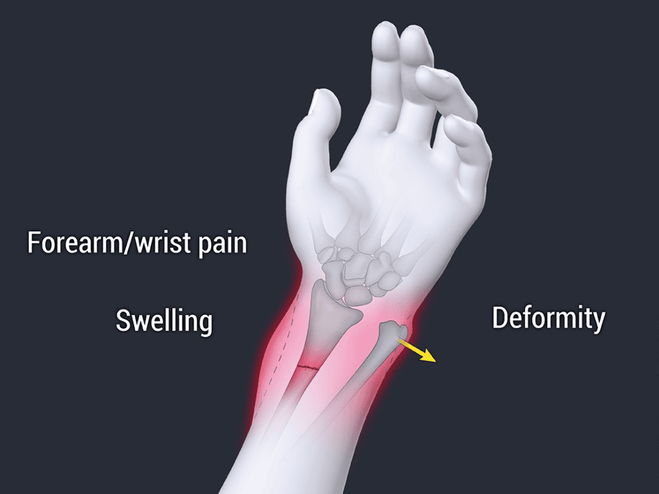 دررفتگی شکستگی گالئازی