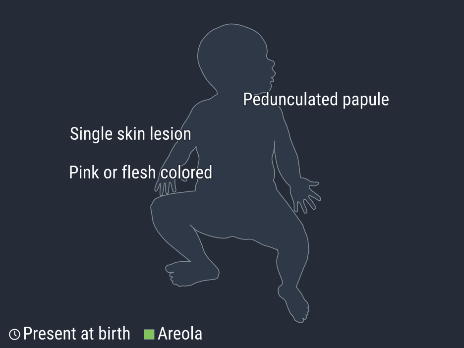 پولیپ ادنکسال پوست نوزاد